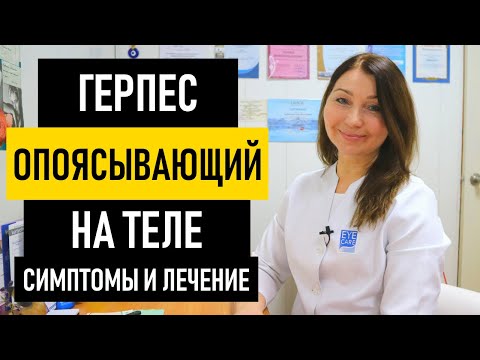 Вопрос: Как жить с опоясывающим герпесом?